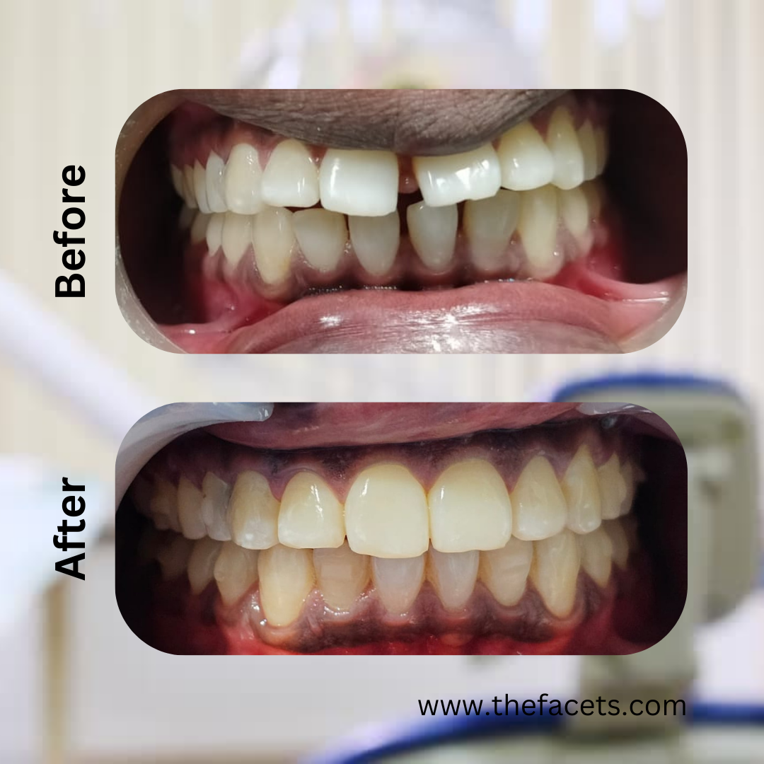 Before After Result 8